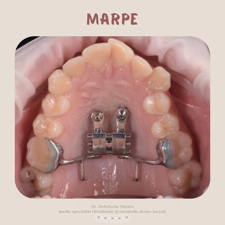 Mai multe aparate ortodontice fixe pe modele dentare printate